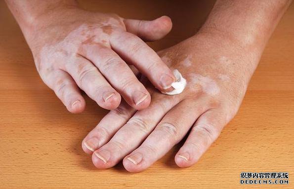 长相奇特的一种常见水果,却是治疗白癜风的良药!